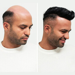 hair replacement Image